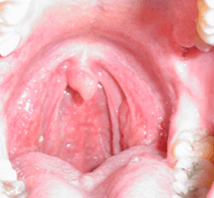 Храп возникает из-за того, что мягкие ткани в задней части горла вибрируют и давят на другую анатомию горла, вызывая сопротивление и турбулентность - звук храпа