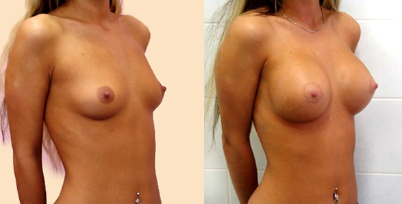Маммопластику груди 3 размера женщины делают не так часто, как нулевого или первого, когда молочные железы совсем маленькие